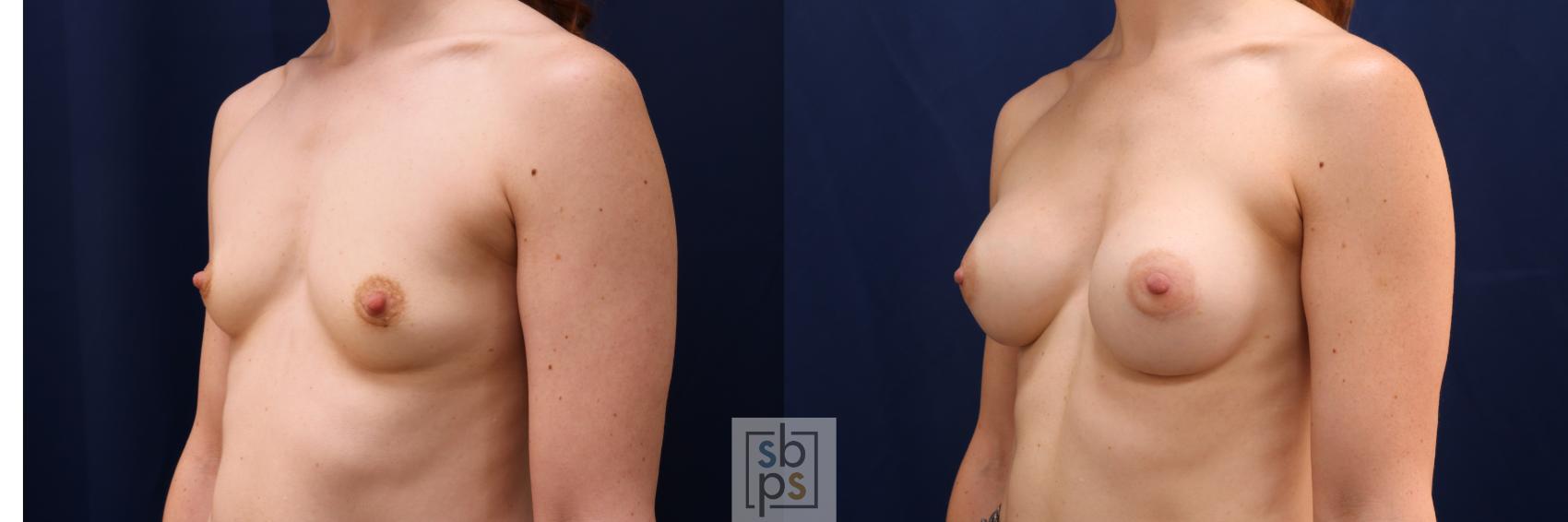 Before & After Breast Augmentation Case 641 Left Oblique View in Torrance & Los Angeles, CA, CA