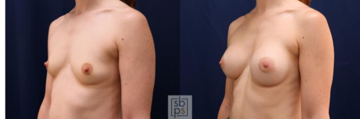 Before & After Breast Augmentation Case 641 Left Oblique View in Torrance, CA