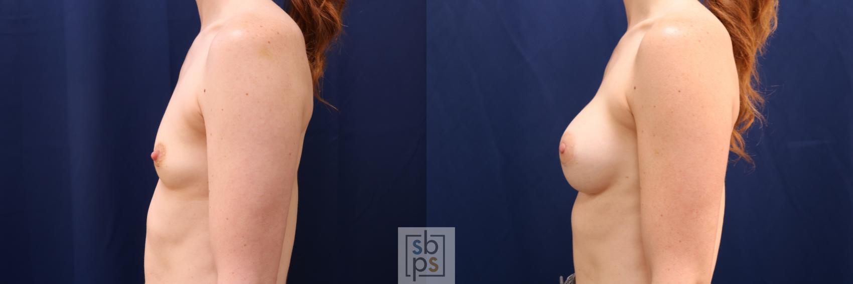 Before & After Breast Augmentation Case 641 Left Side View in Torrance & Los Angeles, CA, CA