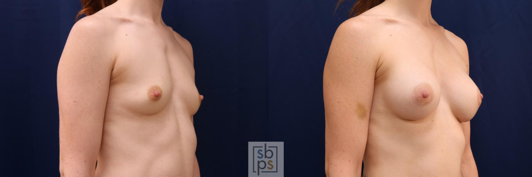 Before & After Breast Augmentation Case 641 Right Oblique View in Torrance & Los Angeles, CA, CA