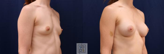 Before & After Breast Augmentation Case 641 Right Oblique View in Torrance, CA