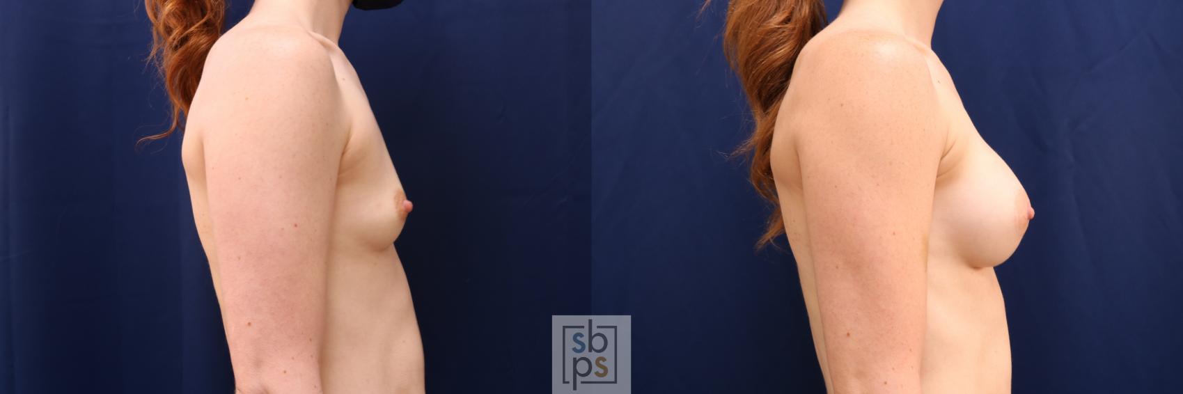 Before & After Breast Augmentation Case 641 Right Side View in Torrance & Los Angeles, CA, CA