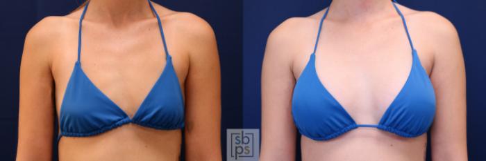 Before & After Breast Augmentation Case 653 Bikini Front View in Torrance, CA