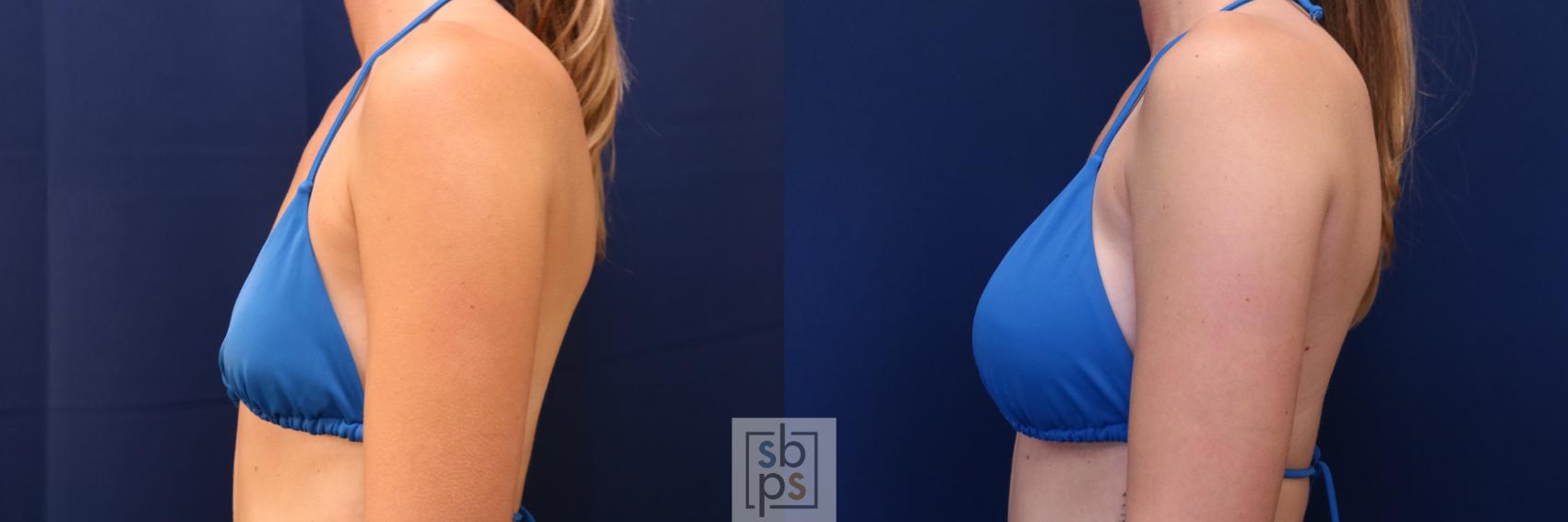 Before & After Breast Augmentation Case 653 Bikini Left View in Torrance & Los Angeles, CA, CA