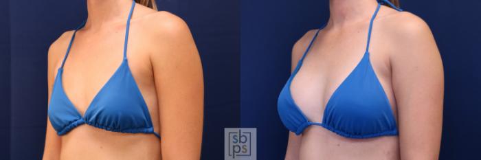 Before & After Breast Augmentation Case 653 Bikini Left Oblique View in Torrance, CA