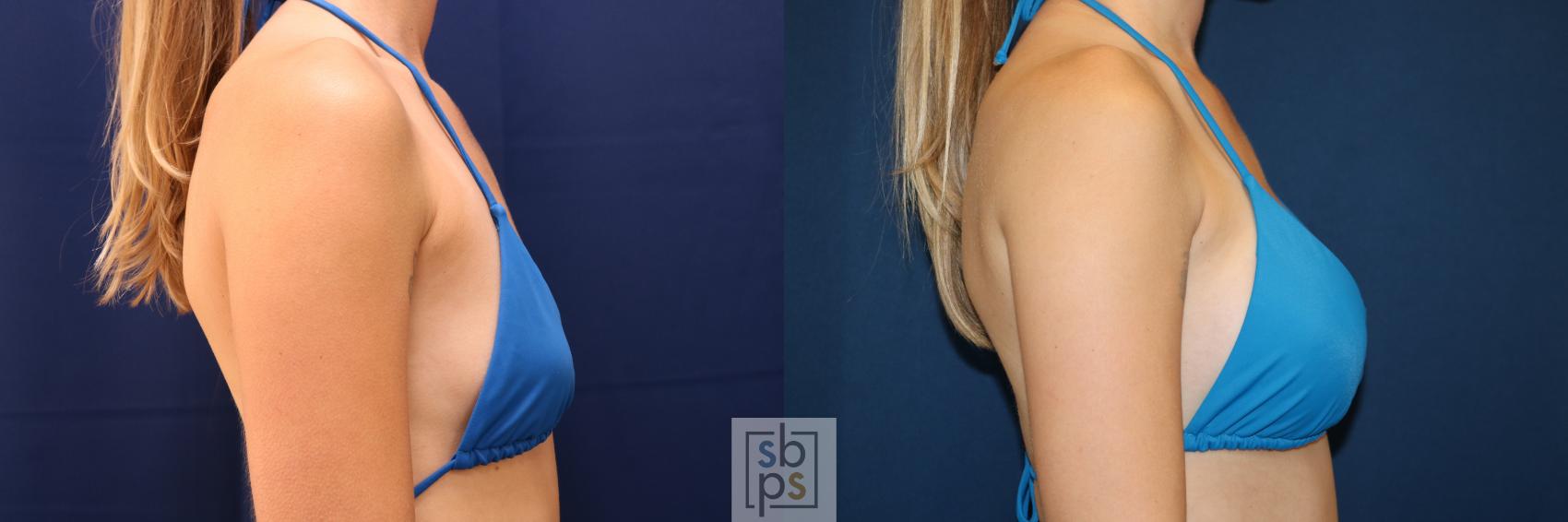 Before & After Breast Augmentation Case 653 Bikini Right View in Torrance & Los Angeles, CA, CA