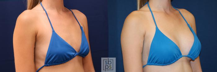 Before & After Breast Augmentation Case 653 Bikini Right Oblique View in Torrance, CA