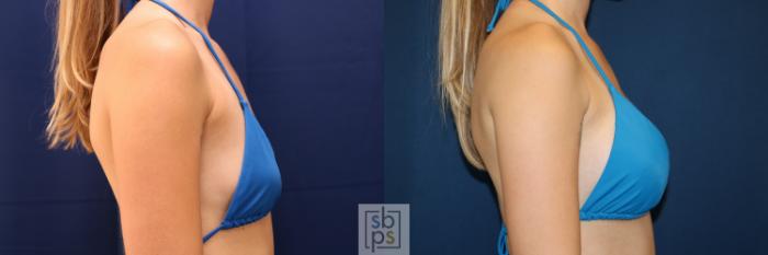 Before & After Breast Augmentation Case 653 Bikini Right View in Torrance, CA