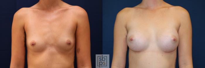 Before & After Breast Augmentation Case 653 Front View in Torrance, CA