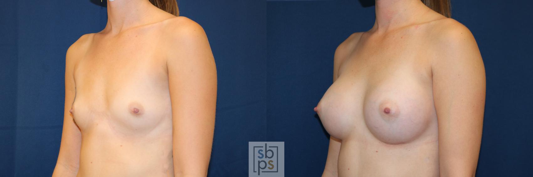 Before & After Breast Augmentation Case 653 Left Oblique View in Torrance & Los Angeles, CA, CA