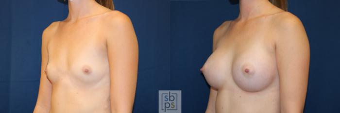 Before & After Breast Augmentation Case 653 Left Oblique View in Torrance, CA