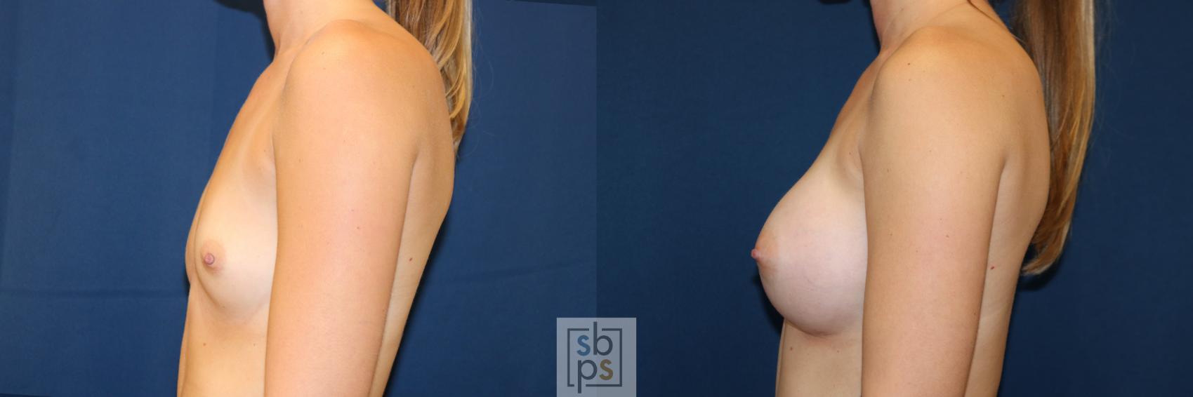 Before & After Breast Augmentation Case 653 Left Side View in Torrance & Los Angeles, CA, CA