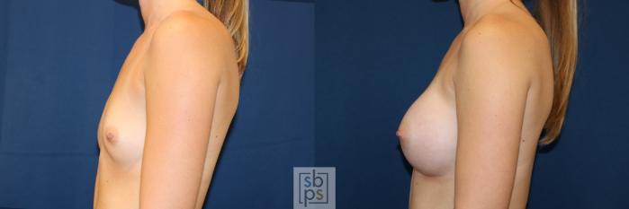 Before & After Breast Augmentation Case 653 Left Side View in Torrance, CA