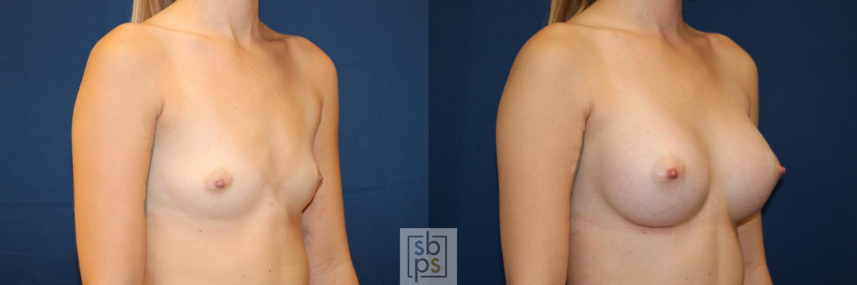Before & After Breast Augmentation Case 653 Right Oblique View in Torrance & Los Angeles, CA, CA