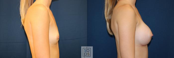 Before & After Breast Augmentation Case 653 Right Side View in Torrance, CA