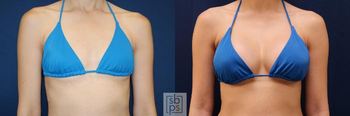Before & After Breast Augmentation Case 657 Bikini Front View in Torrance, CA