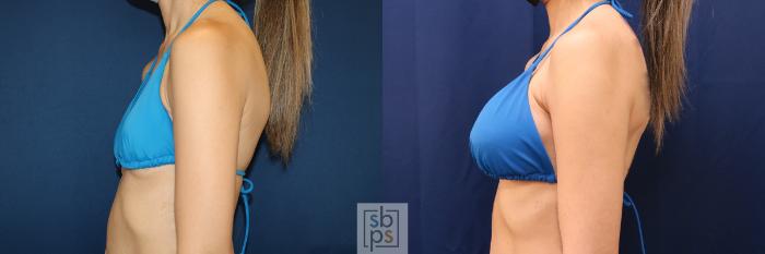 Before & After Breast Augmentation Case 657 Bikini Left View in Torrance, CA