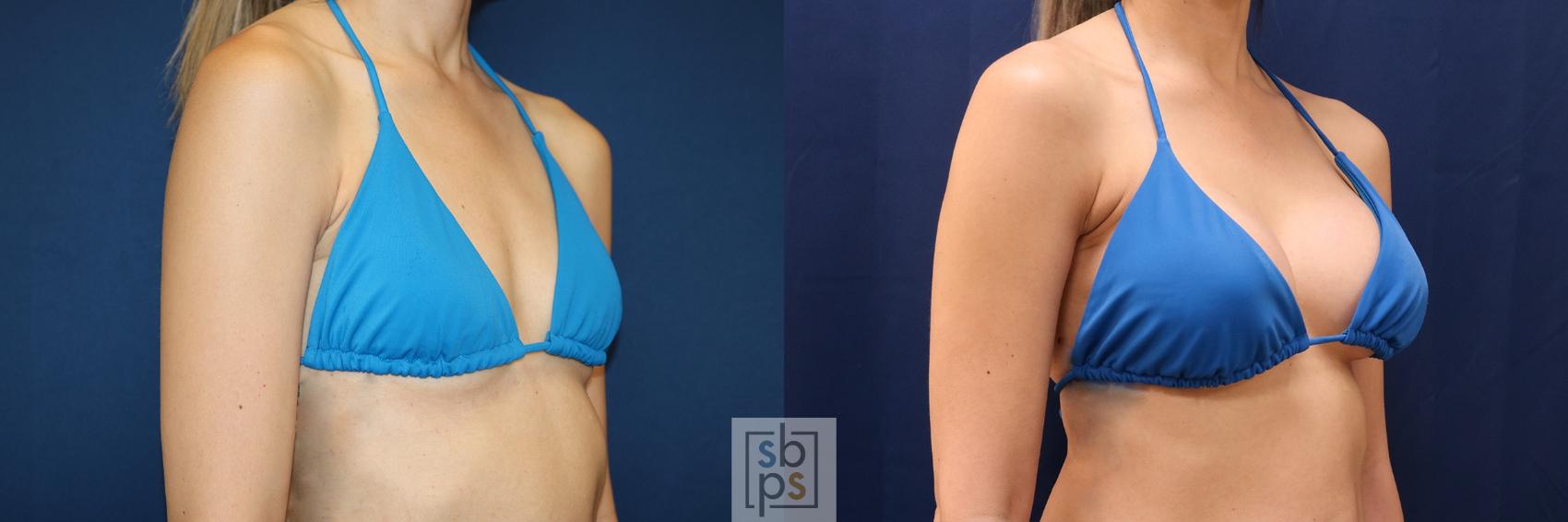 Before & After Breast Augmentation Case 657 Bikini Right Oblique View in Torrance & Los Angeles, CA, CA