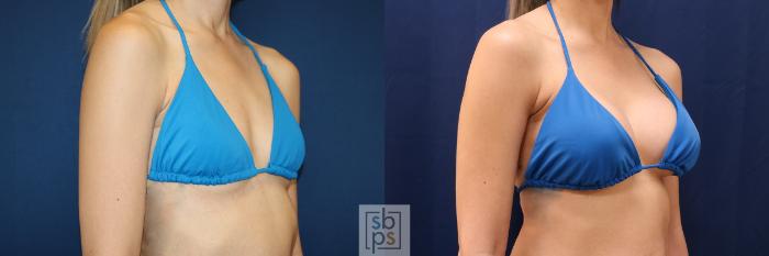 Before & After Breast Augmentation Case 657 Bikini Right Oblique View in Torrance, CA