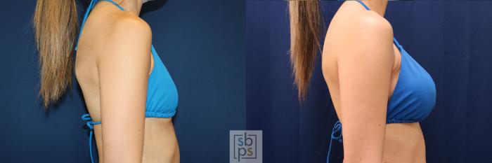 Before & After Breast Augmentation Case 657 Bikini Right View in Torrance, CA