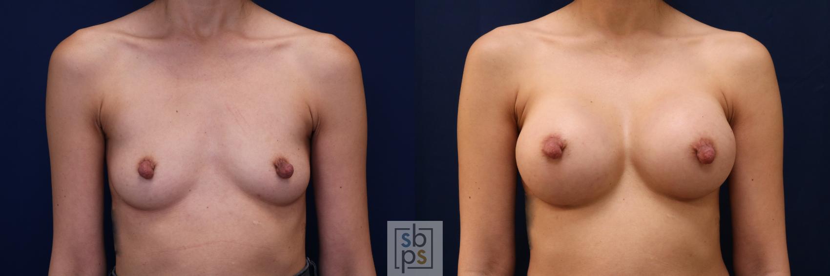 Before & After Breast Augmentation Case 657 Front View in Torrance, CA