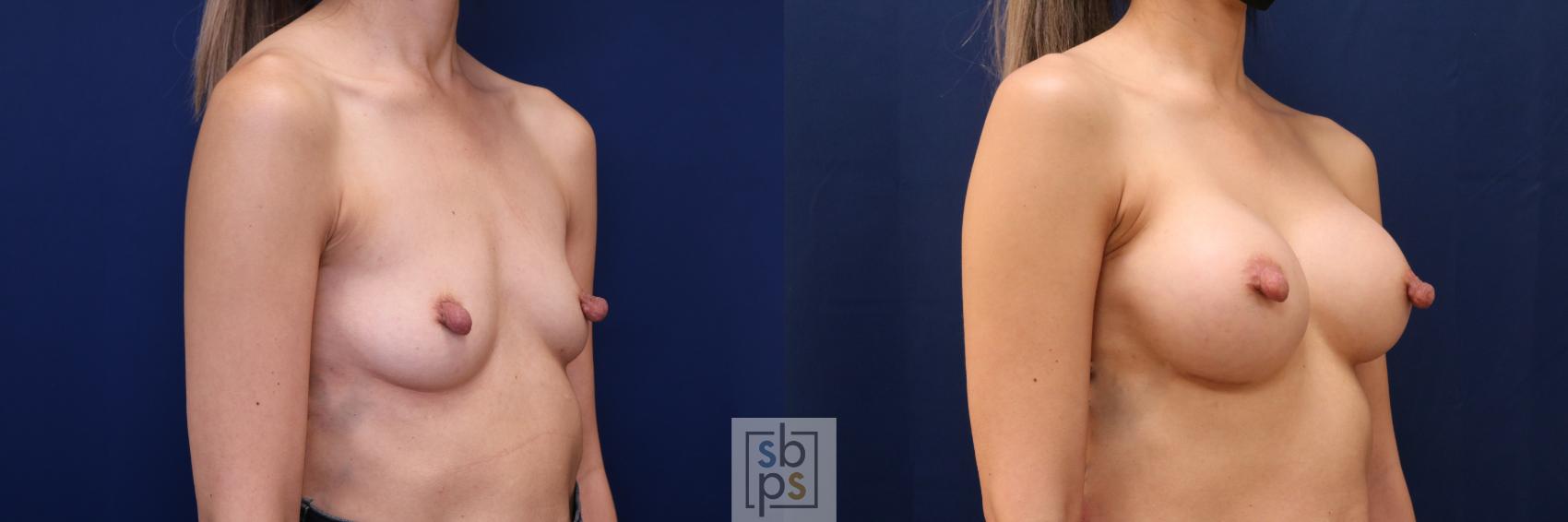 Before & After Breast Augmentation Case 657 Right Oblique View in Torrance & Los Angeles, CA, CA
