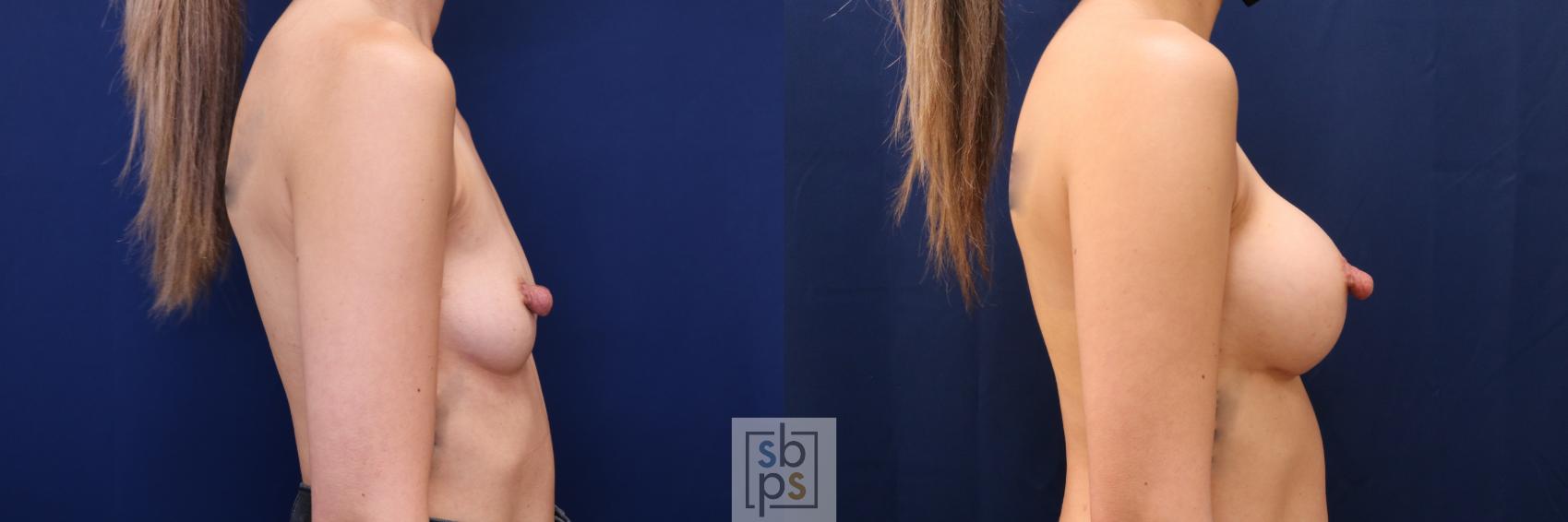 Before & After Breast Augmentation Case 657 Right Side View in Torrance & Los Angeles, CA, CA