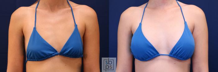 Before & After Breast Augmentation Case 658 Bikini Front View in Torrance, CA