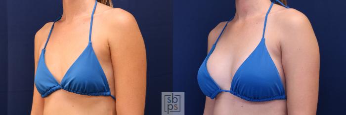 Before & After Breast Augmentation Case 658 Bikini Left Oblique View in Torrance, CA