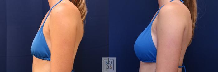 Before & After Breast Augmentation Case 658 Bikini Left View in Torrance, CA
