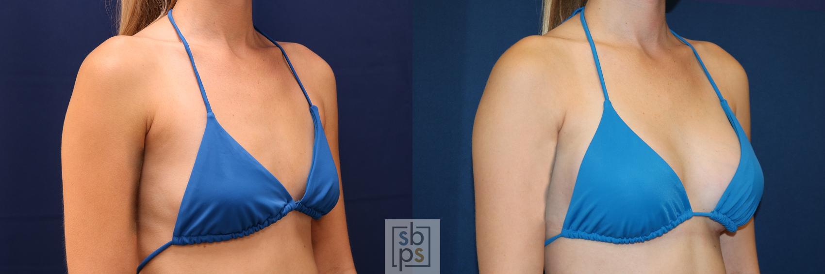 Before & After Breast Augmentation Case 658 Bikini Right Oblique View in Torrance & Los Angeles, CA, CA