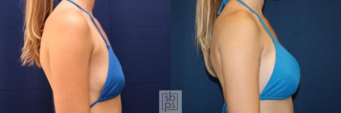 Before & After Breast Augmentation Case 658 Bikini Right View in Torrance, CA