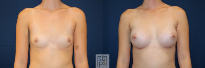 Before & After Breast Augmentation Case 658 Front View in Torrance, CA