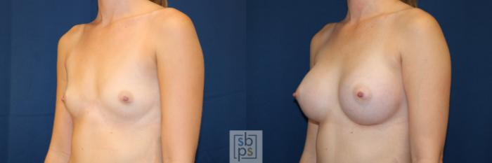 Before & After Breast Augmentation Case 658 Left Oblique View in Torrance, CA