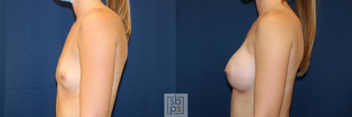 Before & After Breast Augmentation Case 658 Left Side View in Torrance, CA