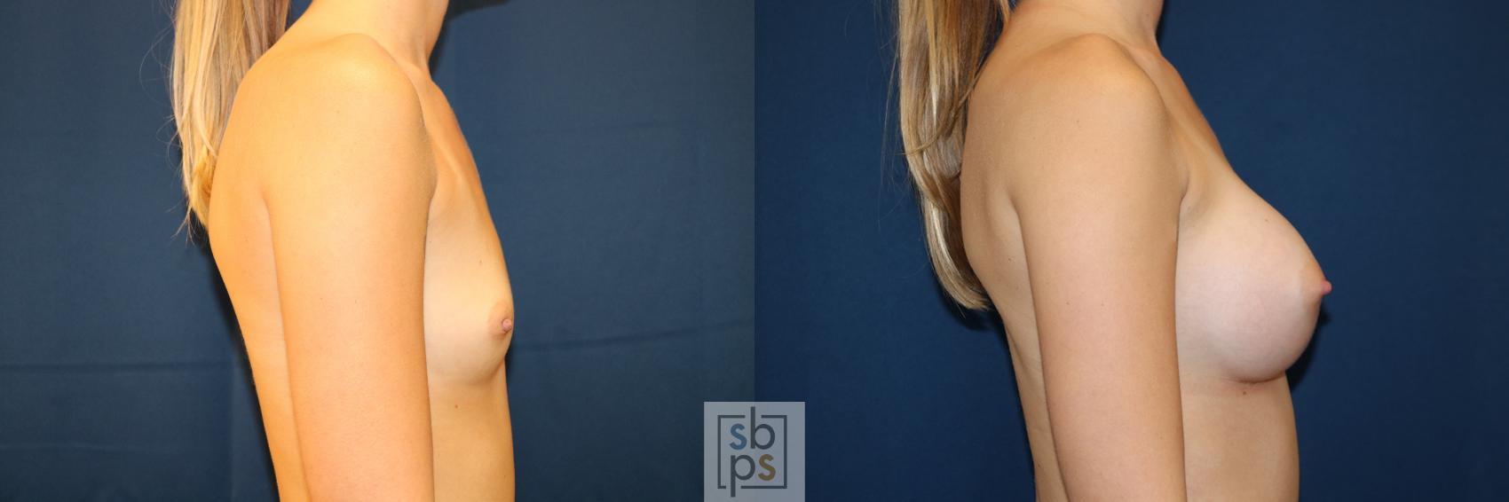 Before & After Breast Augmentation Case 658 Right Side View in Torrance & Los Angeles, CA, CA