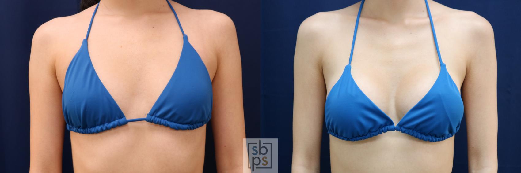 Before & After Breast Augmentation Case 660 Bikini Front View in Torrance & Los Angeles, CA, CA