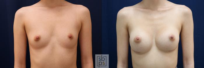 Before & After Breast Augmentation Case 660 Front View in Torrance, CA