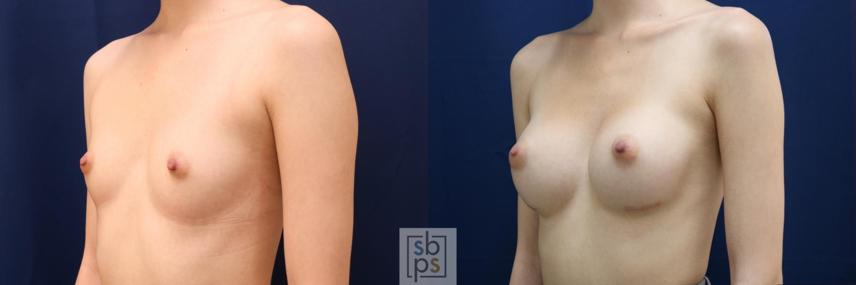 Before & After Breast Augmentation Case 660 Left Oblique View in Torrance & Los Angeles, CA, CA