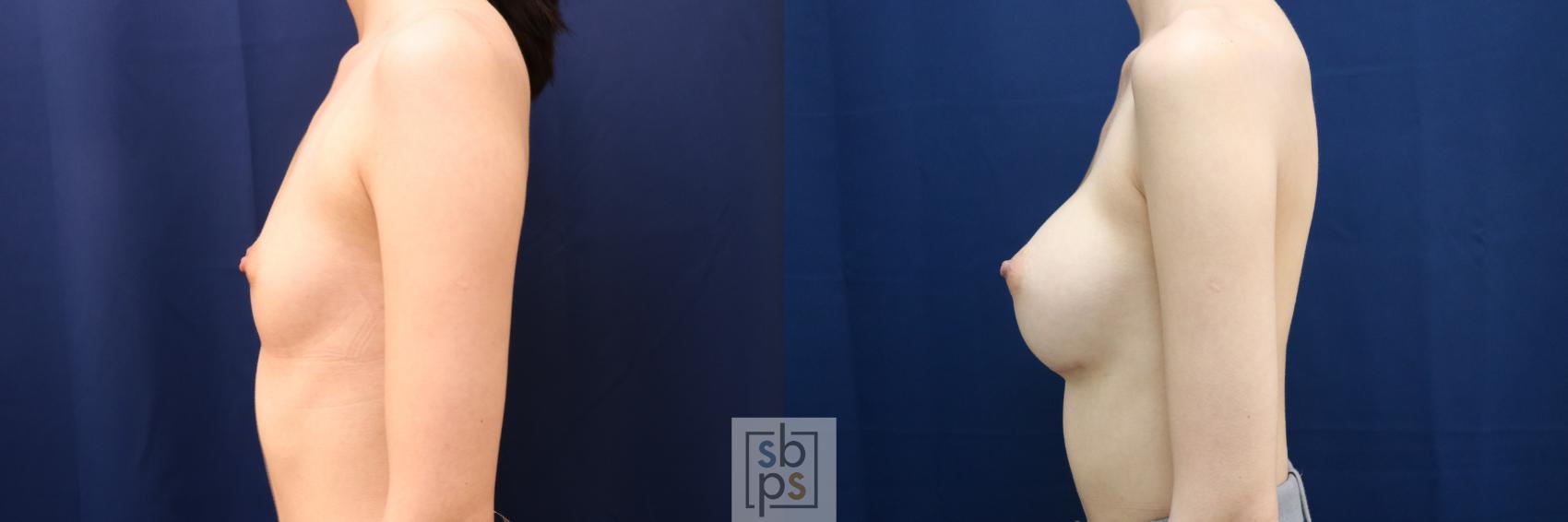 Before & After Breast Augmentation Case 660 Left Side View in Torrance & Los Angeles, CA, CA