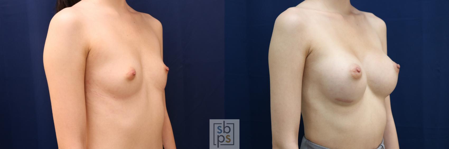 Before & After Breast Augmentation Case 660 Right Oblique View in Torrance & Los Angeles, CA, CA