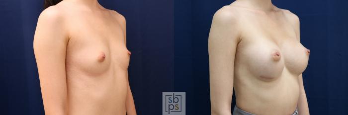 Before & After Breast Augmentation Case 660 Right Oblique View in Torrance, CA