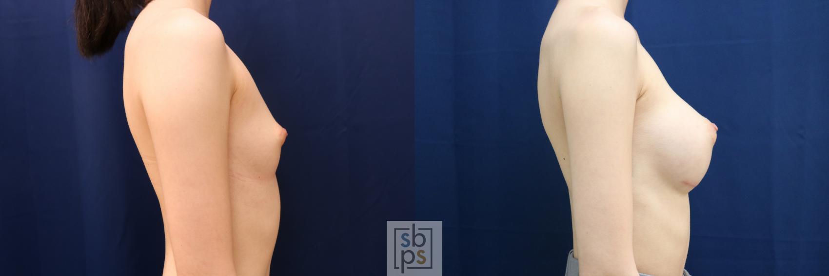 Before & After Breast Augmentation Case 660 Right Side View in Torrance & Los Angeles, CA, CA