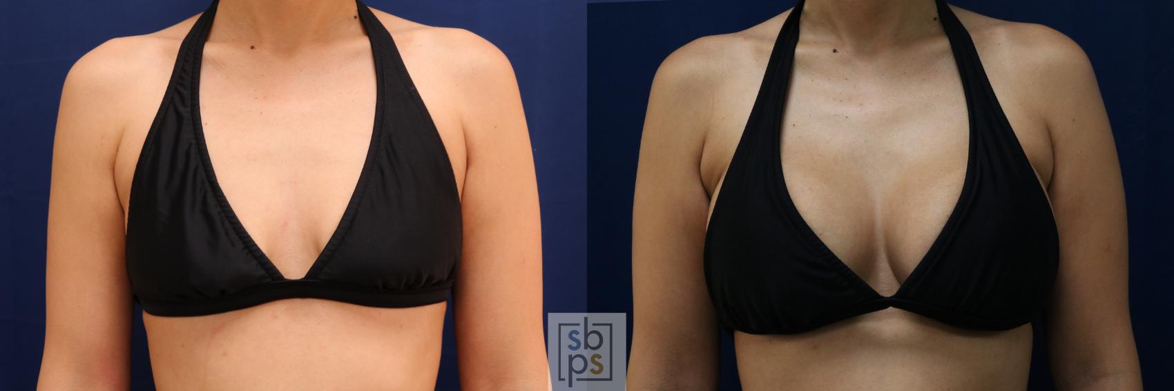 Before & After Breast Augmentation Case 662 Bikini Front View in Torrance & Los Angeles, CA, CA