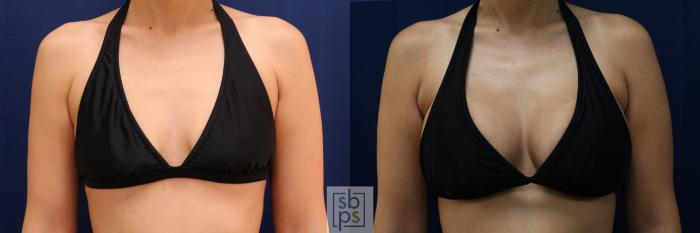 Before & After Breast Augmentation Case 662 Bikini Front View in Torrance, CA