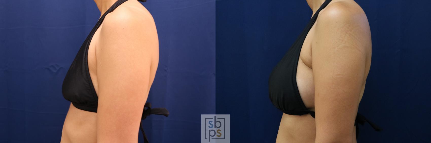 Before & After Breast Augmentation Case 662 Bikini Left View in Torrance & Los Angeles, CA, CA