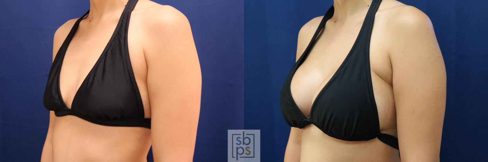 Before & After Breast Augmentation Case 662 Bikini Left Oblique View in Torrance & Los Angeles, CA, CA