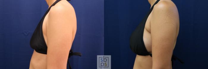 Before & After Breast Augmentation Case 662 Bikini Left View in Torrance, CA