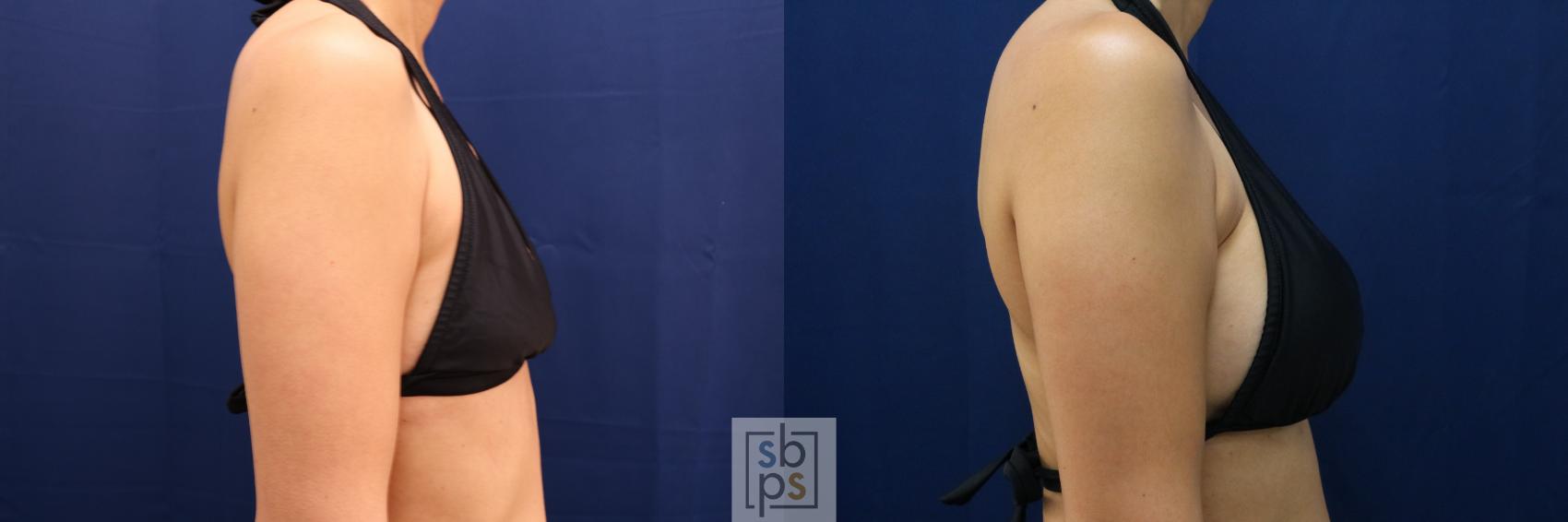 Before & After Breast Augmentation Case 662 Bikini Right View in Torrance & Los Angeles, CA, CA