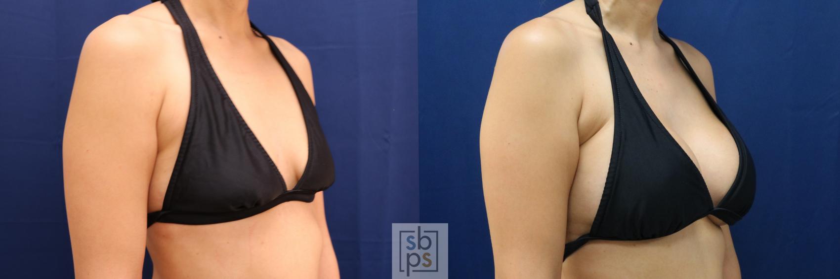 Before & After Breast Augmentation Case 662 Bikini Right Oblique View in Torrance & Los Angeles, CA, CA
